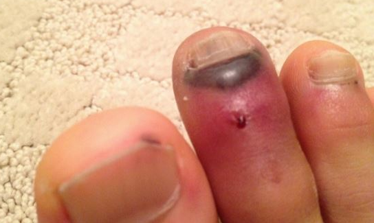 Blood Blister on Toe