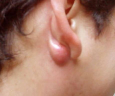 Lump behind Ear: Causes, Symptoms, on Neck, Piercing, Mastoiditis ...