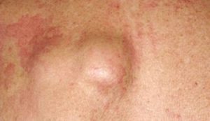 Lump behind Knee Baker’s Cyst Causes, Symptoms, Images, Pain, Knee