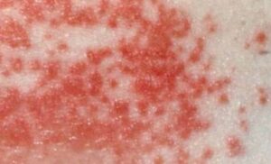 Rash under Breast, Causes, Pictures, Itchy, Treatment, Get Rid - Treat MD