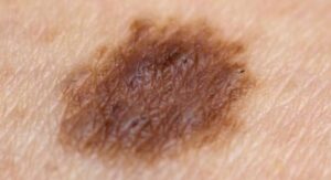 Mole on Arm Meaning, Pictures, Raised, Swollen, Painful, Cancer, Mole