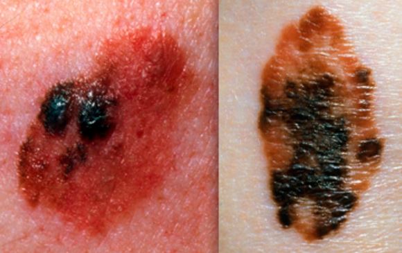 Mole on Arm Meaning, Pictures, Raised, Swollen, Painful, Cancer, Mole