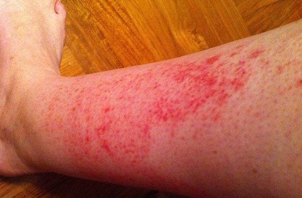 Rash On Arms And Legs Itchy Red Causes Small Bumps Pictures Not