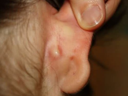Lump behind Ear: Causes, Symptoms, on Neck, Piercing, Mastoiditis ...