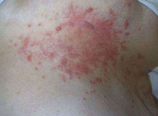icd 10 code for yeast infection under breast