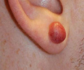 Abscess on Ear Lobe