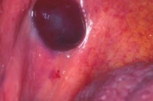 painful bumps on buttocks cheek painful bumps on buttocks cheek