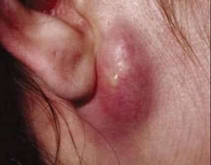 Ear infection causing Bumps behind Ears