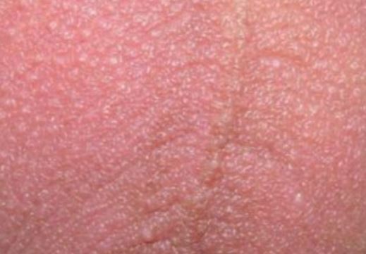 Fordyces spots on scrotum Treat MD epididymitis-and-orchitis-harvard-health