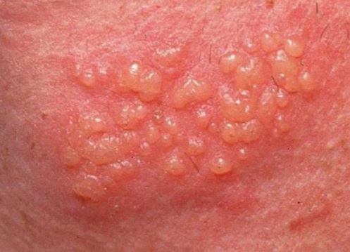 Genital Herpes Symptoms