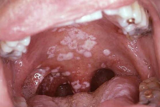 Picture of white Patches in Mouth and Throat