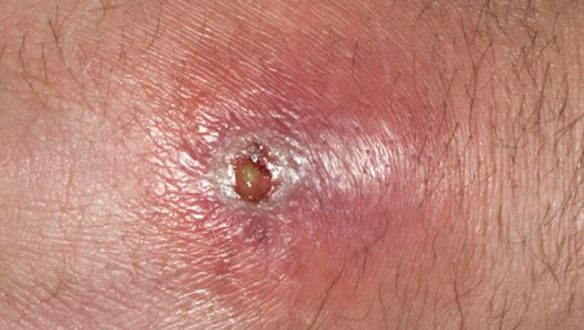 Boils under Armpit, Causes, Pictures, Symptoms Ge Rid