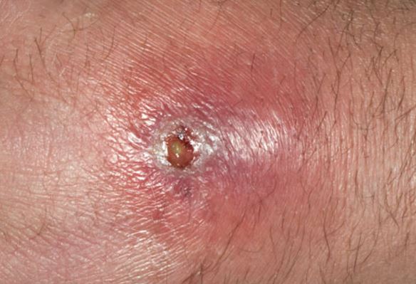 Ingrown Hair Armpit Boil