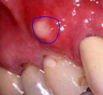 Pimple-like Bump on Gum