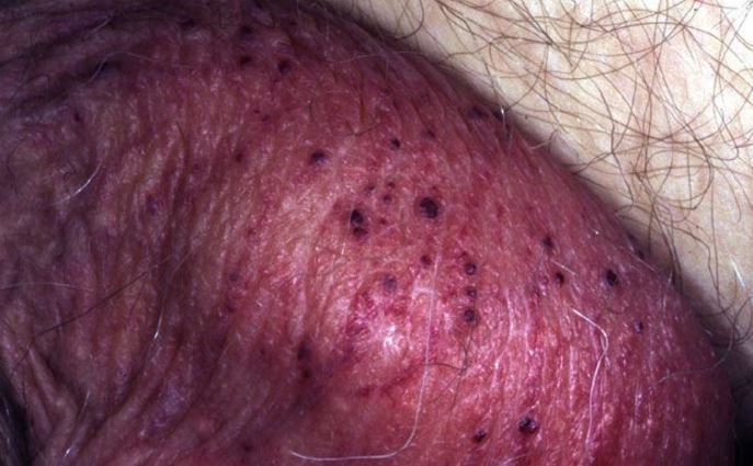 Blood Blisters On Scrotum  Causes  Pictures  Red  Itchy