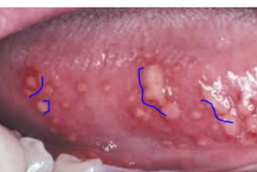 Small White Bumps on Tongue