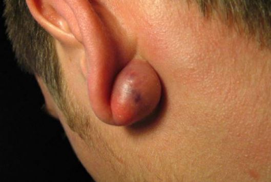 Ear Lobe Swollen Picture