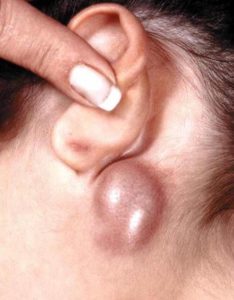Swollen Lymph Nodes Behind Ear Cancer, Causes, Symptoms, Pictures