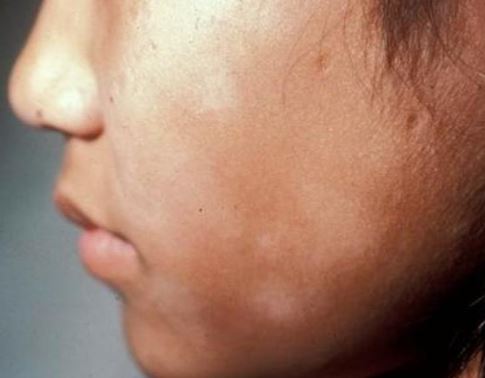 What Causes White Spots On Face What Causes White Spots On Face