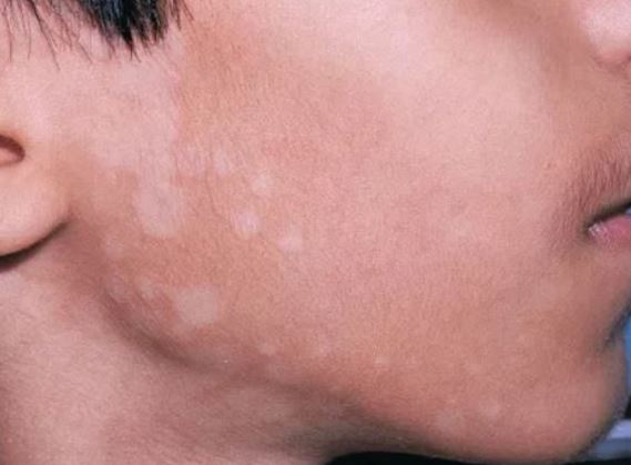 White Spots on Skin