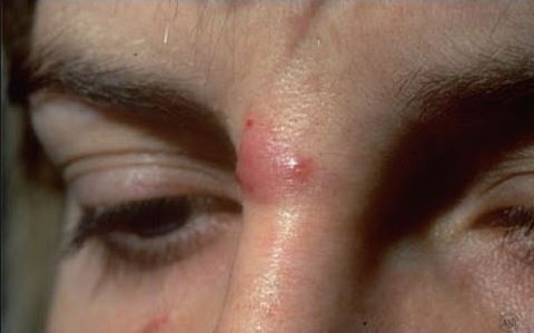 A Picture of Cyst on Nose