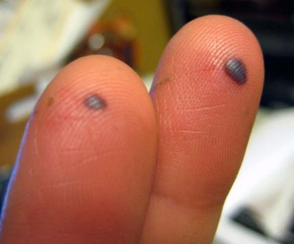 Blood Blister on Fingers