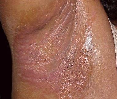 Eczema or Contact dermatitis causing intense itch underarm