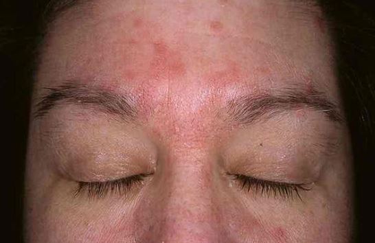 Dry skin Under Eyebrows Itchy