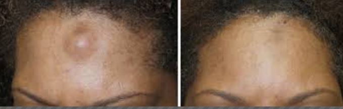 Forehead Osteomas before and after Treatment Picture