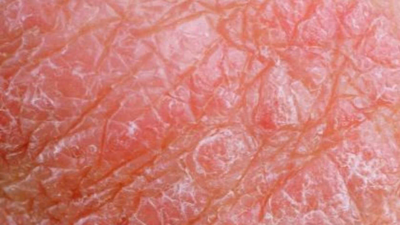 Itchy Scrotum, Balls, Causes, Syndrome, Red, STD, At Night, No Rash, Dry  Skin, Pictures, How to Stop, Cure, Treat, Home Remedies