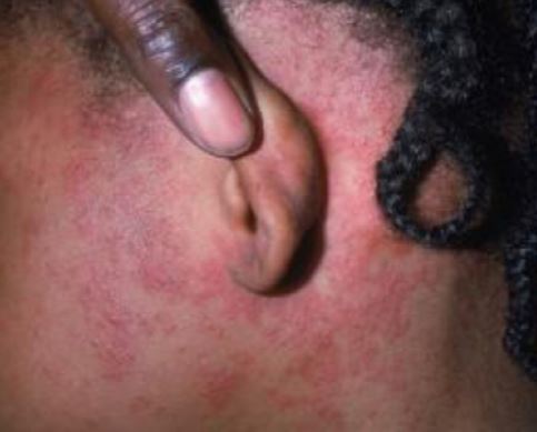 Rash Behind Ear, Neck, Causes, Itchy, Symptoms, Pictures, Small Bumpy ...