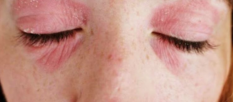 Rash around Eyes Picture