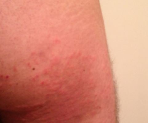 Rash on Buttocks and Thighs