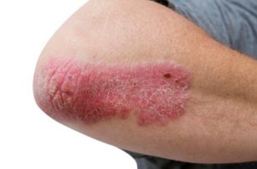 Rash on Elbow Picture