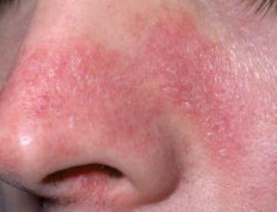 Rash on Nose