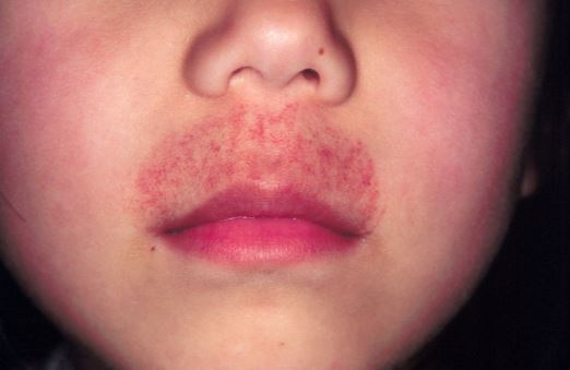 Rash On Nose Around Mouth Upper Lips Dry Skin Causes Wont Go Away