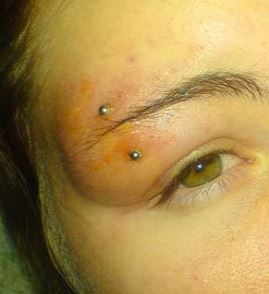 Swollen Eyebrow Piercing