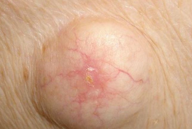 Underarm Cyst Picture
