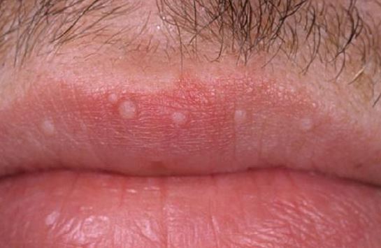 White Bumps on Lips - HPV