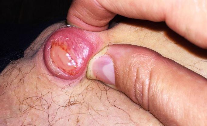 A Sebaceous Thigh Cyst image