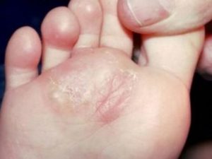 swimmers itch feet swimmers itch feet