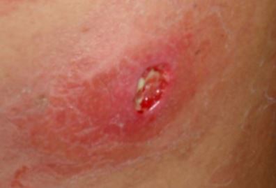 Deep Infected Ingrown Hair photo