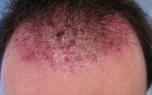 Ingrown Hair On Scalp Head Cyst Pictures Causes Symptoms And How To