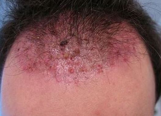 Ingrown Hair on Scalp Picture