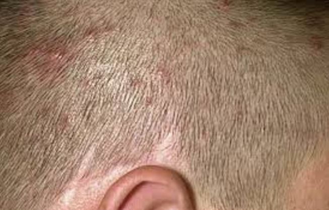 Itchy Bumps On Scalp Neck Causes Red Hurts Pictures Raised Small