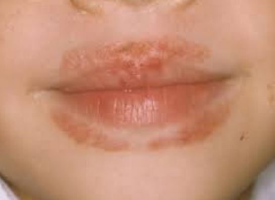 Itchy Lips, Causes,  in the manner of Bumps, Swollen, Allergy, After  