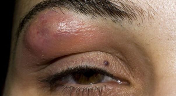 Lump in Eyebrow, Bone, Causes above Eyebrow, Cancer, Headache, Hard, Painful, How to Get Rid