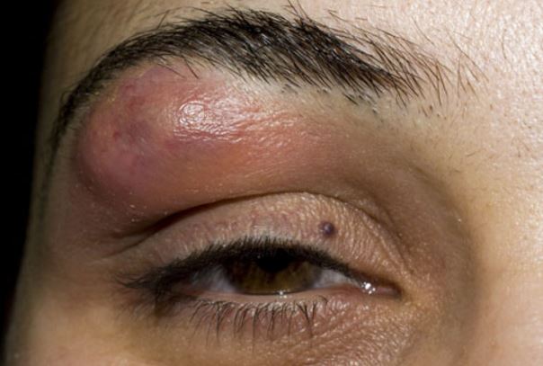 Lump on Eyebrow above Eye