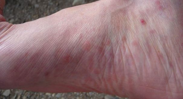 Bumps On Bottom Of Feet Red White Small Painful Hurt That Itch