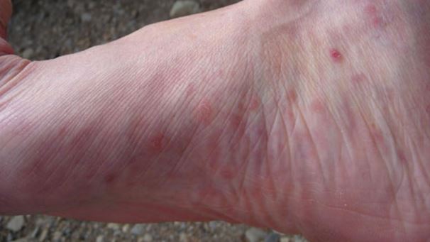 Red Small Bumps on Sole of Foot caused by Lichen Planus